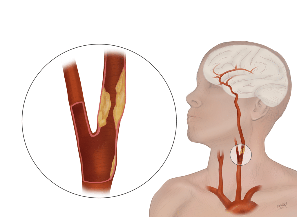 Carotid Artery Disease1