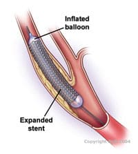 Carotid stenting 3