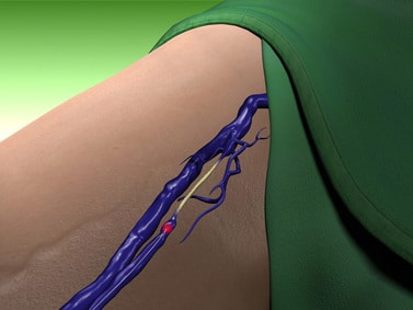 Laser Closure Procedure 2