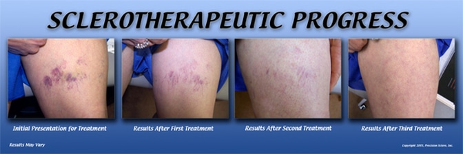 Sclerotherapeutic Progress